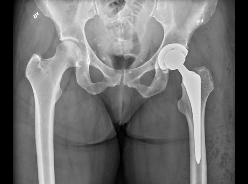 Hip Replacement